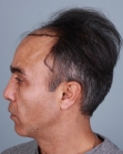 Before Hair Transplant&nbsp;Front